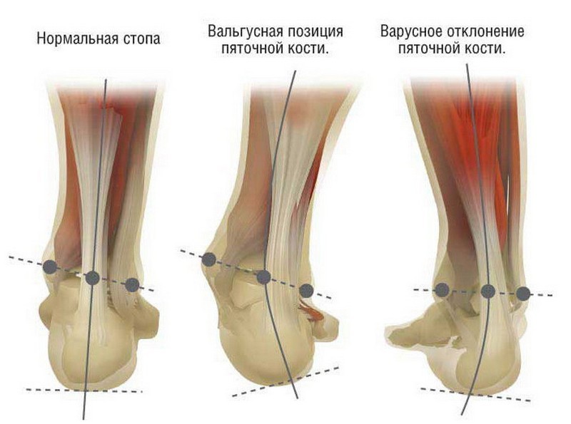 Вальгусная лечение стопы Владивосток