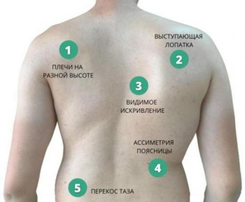 Причины, диагностика, лечение сколиоза во Владивостоке