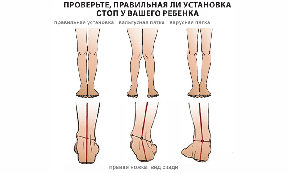 Вальгусная лечение стопы Владивосток