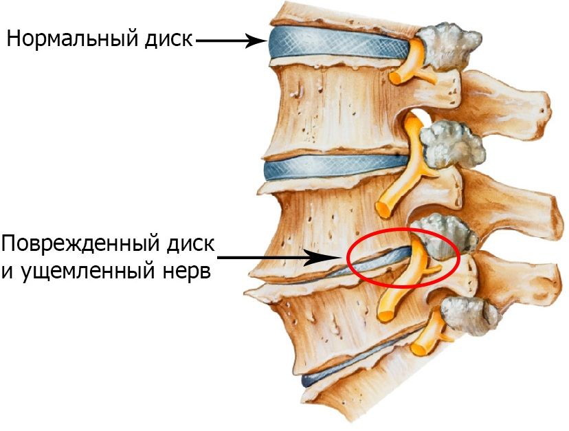 Мануальная терапия при остеохондрозе во Владивостоке