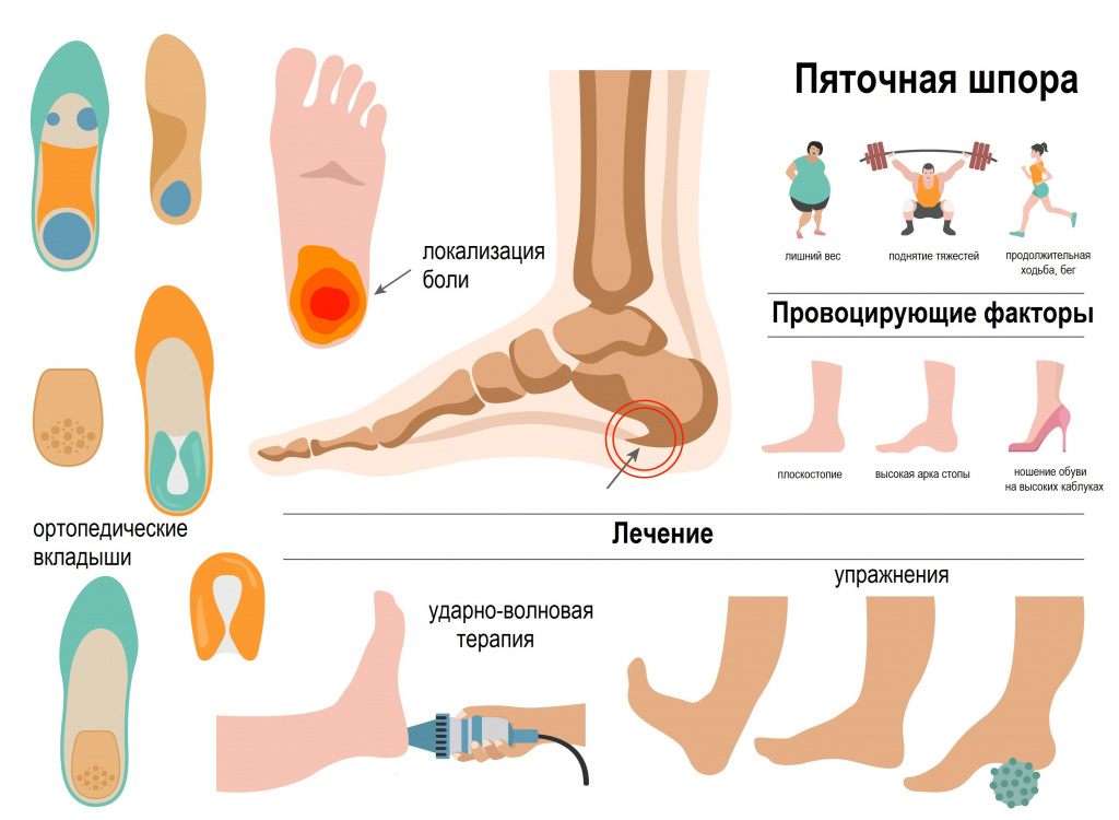 Лечение пяточной шпоры во Владивостоке
